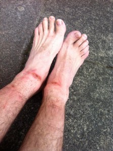 Plasters and new socks required